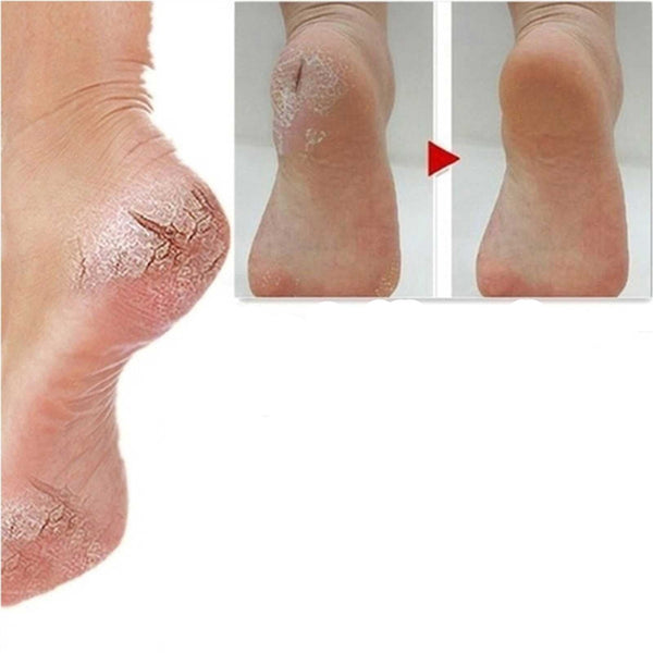Skin Care Callus Crack Repair Cream
